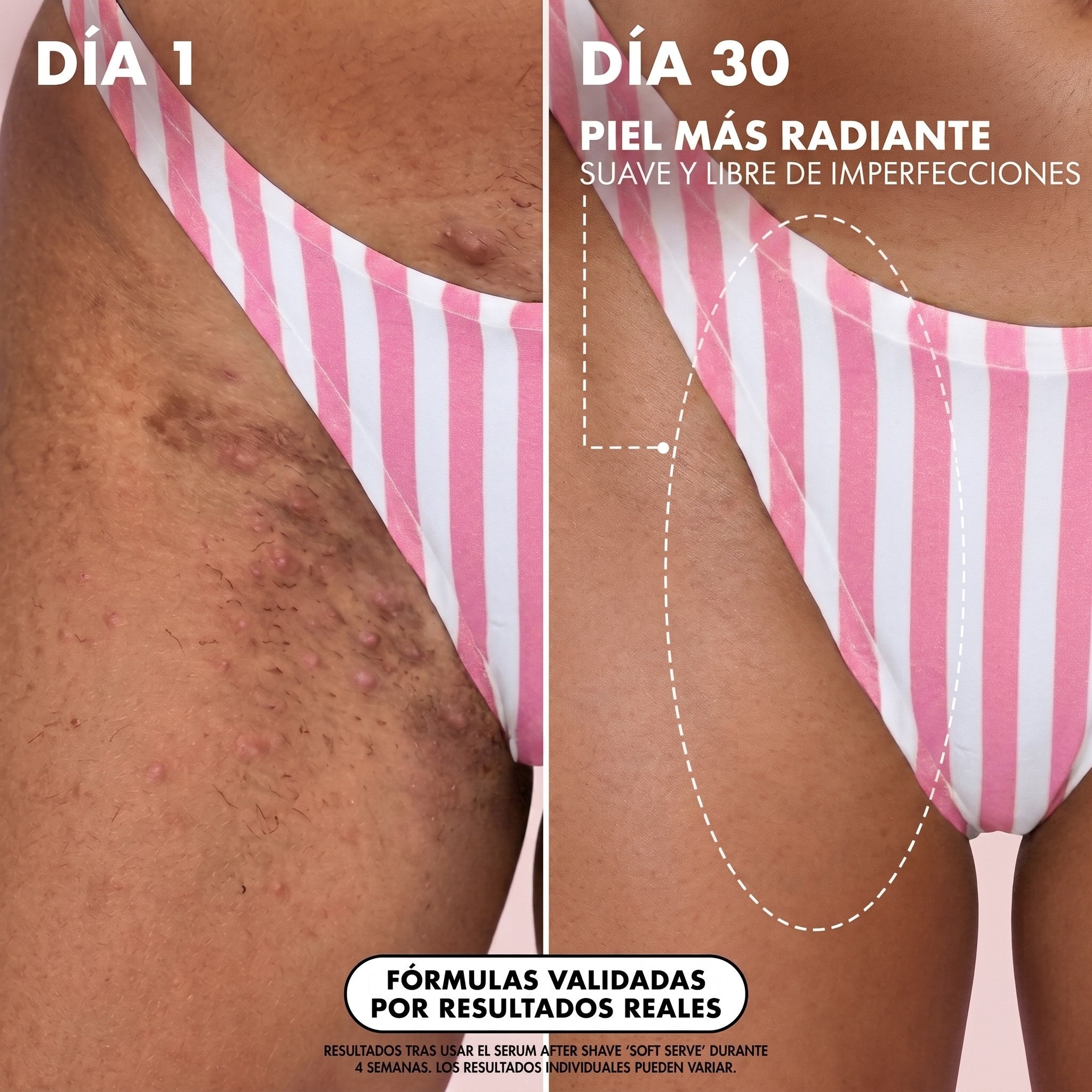 Comparativa de la piel de la ingle antes y después de cuatro semanas de uso